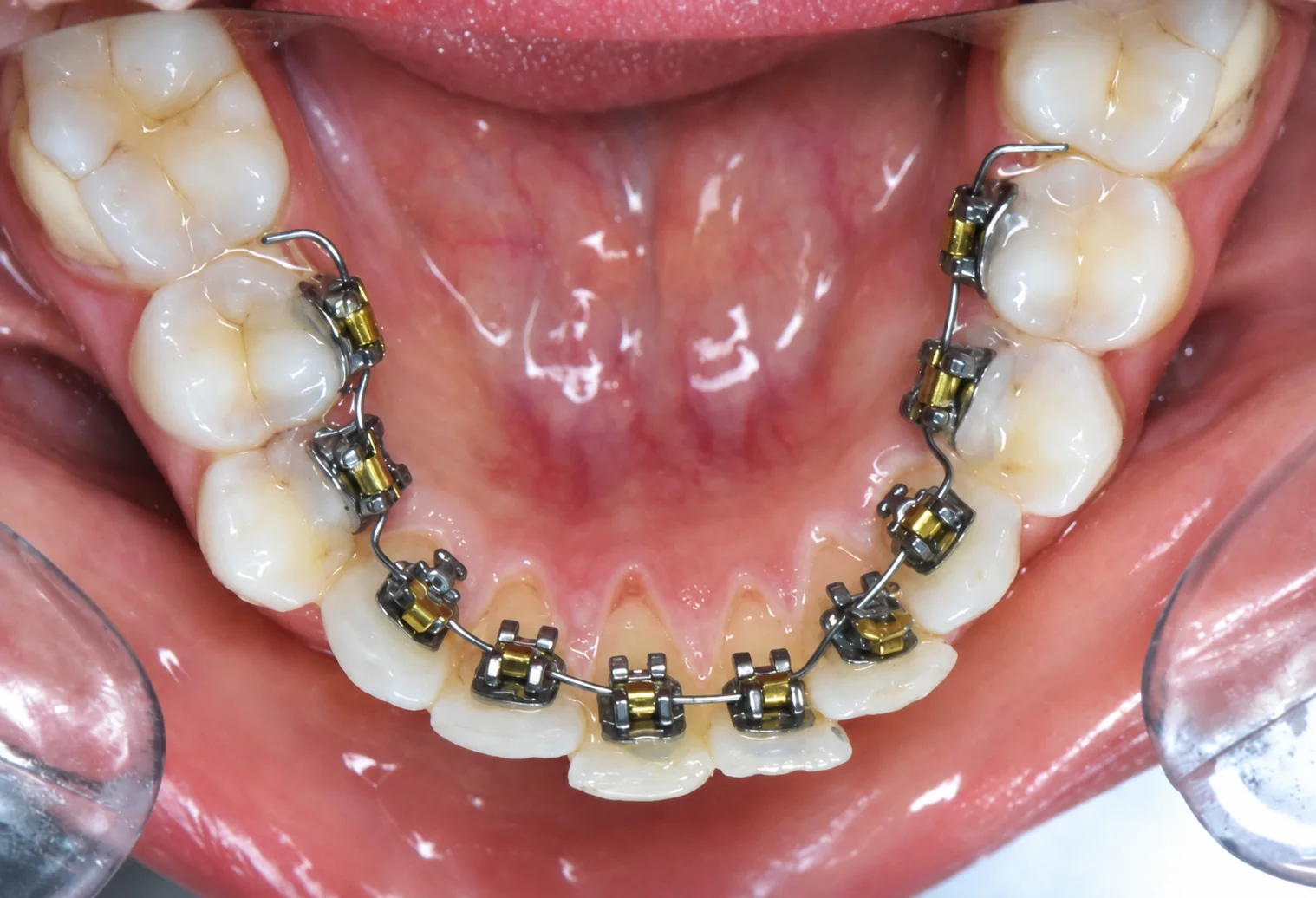 Appareil d'orthodontie linguale posé sur l'arcade inférieure, attaches collées côté langue