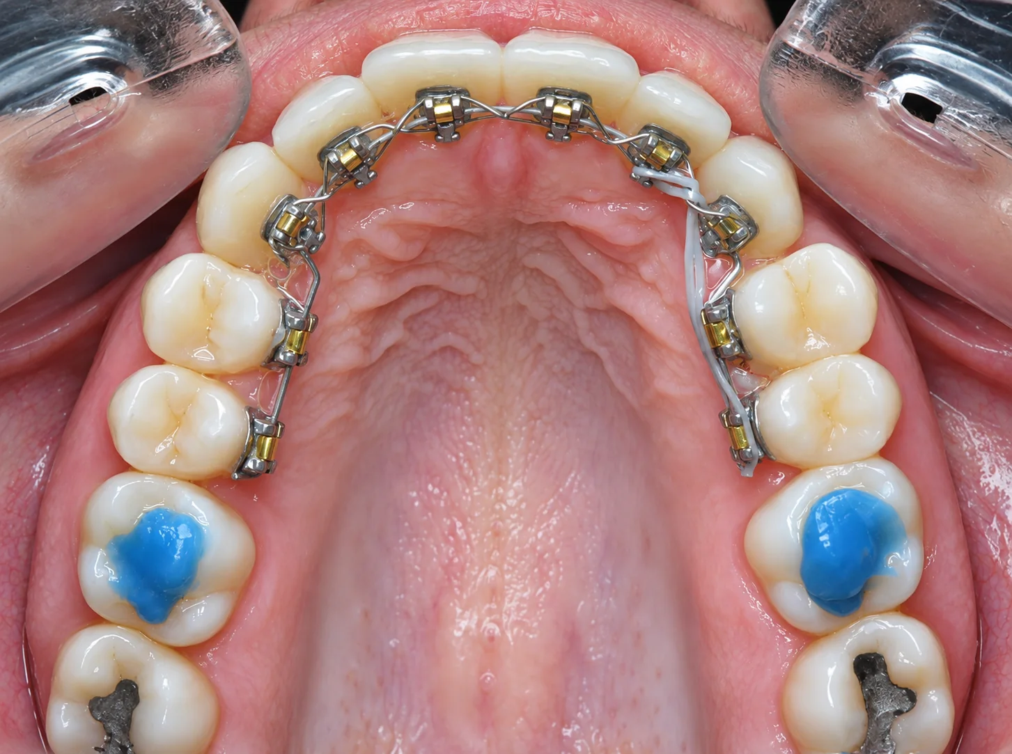 Appareil d'orthodontie linguale posé sur la face interne des dents de l'arcade supérieure