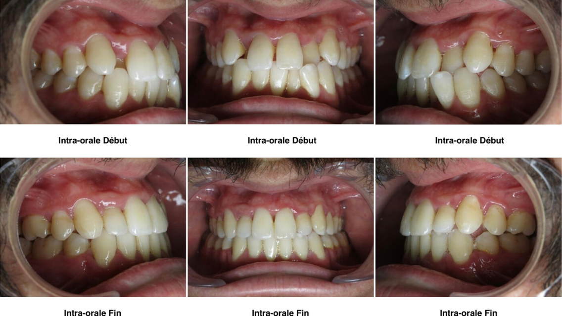 Eccombrement Dentaire Orthondontiste Nanterre 3