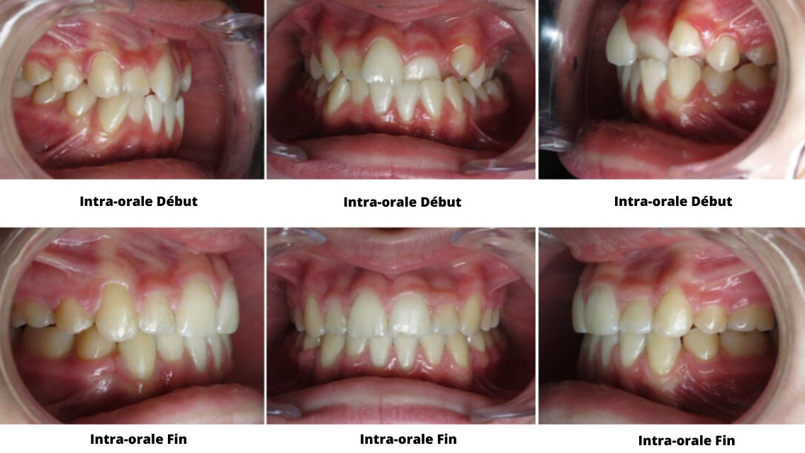 Eccombrement Dentaire Orthondontiste Nanterre 4