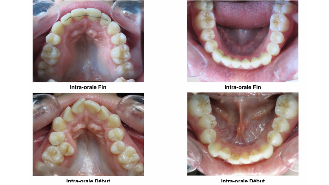 Eccombrement Dentaire Orthondontiste Nanterre 5