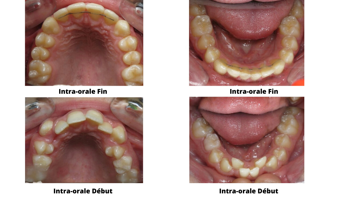 Eccombrement Dentaire Orthondontiste Nanterre 6