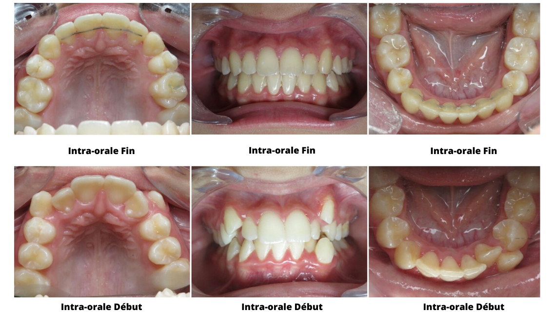 Eccombrement Dentaire Orthondontiste Nanterre 7