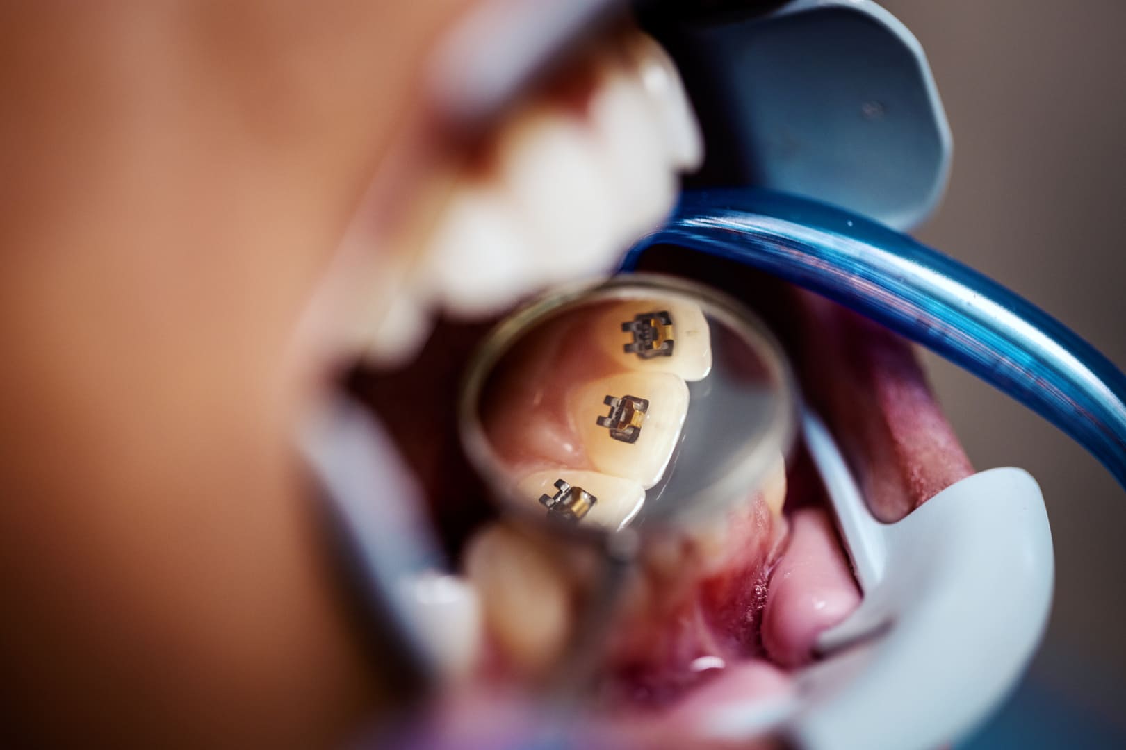 Orthodontie linguale : l’appareil placé derrière les dents